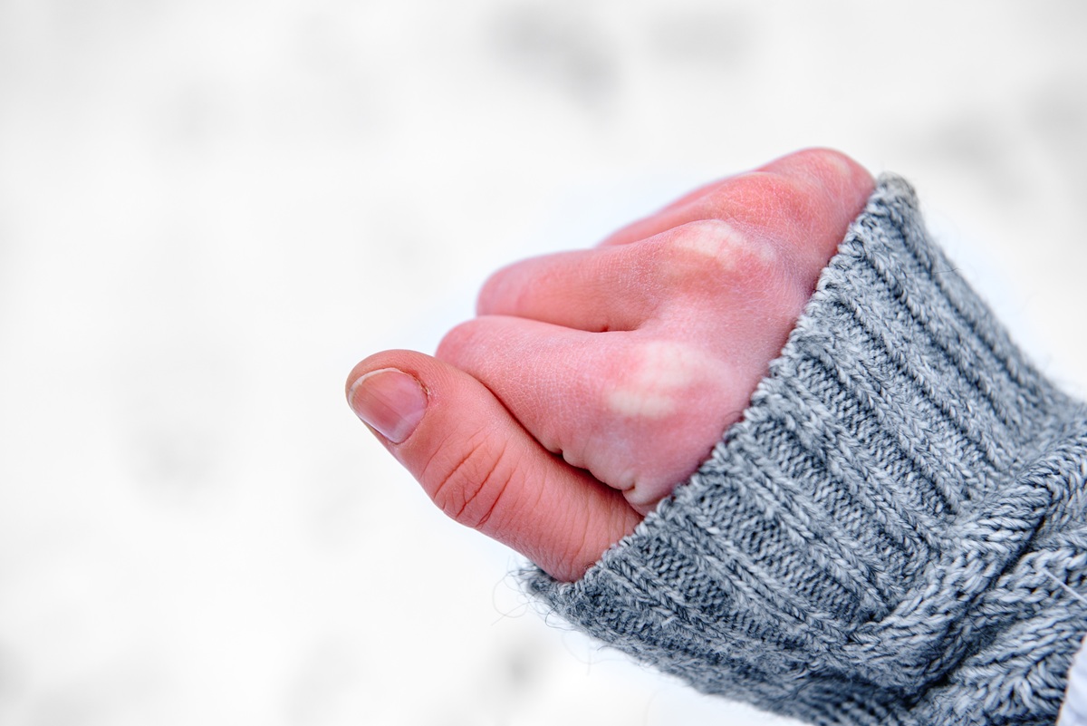 Сухие руки зимой